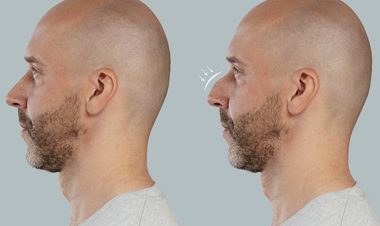 Las mejores clínicas de rinoplastia en Lima: hombre muestra resultados de su rinoplastia.