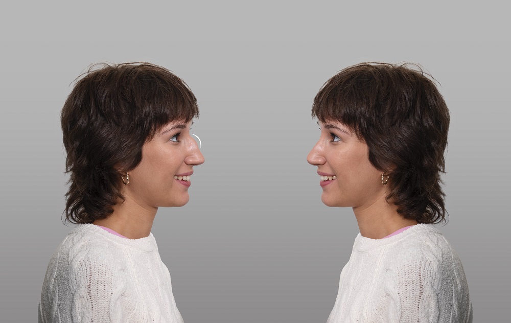 Rinoplastia nariz aguileña: resultados