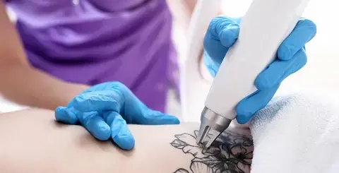 Eliminar-tatuajes-a-través-de-la-cirugía