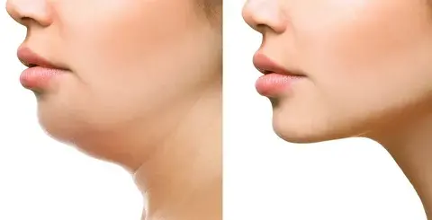 Tratamiento-estético-para-eliminar-la-papada