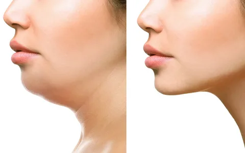 Tratamiento-estético-para-eliminar-la-papada