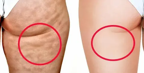 eliminar-la-celulitis