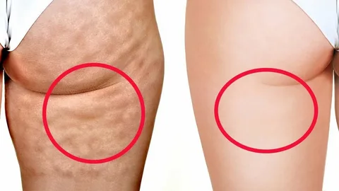 eliminar-la-celulitis