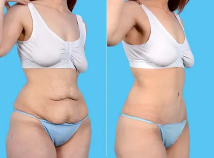 lipotransferencia