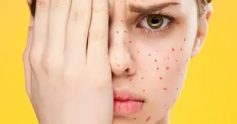 manchas-de-la-varicela