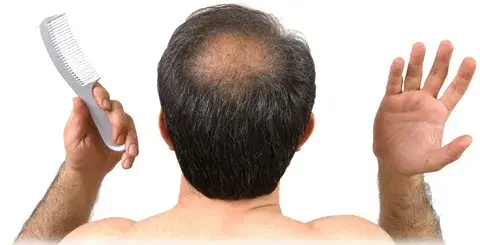 se-cae-el-cabello-en-los-hombres