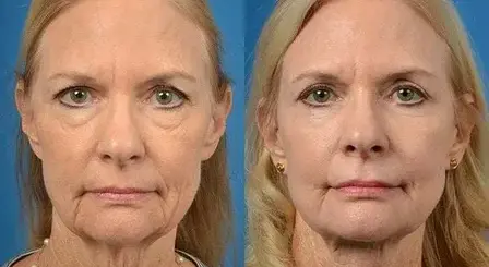 En-qué-consiste-el-lifting-de-la-frente