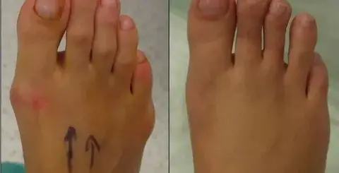 La-irugía-estética-de-pies