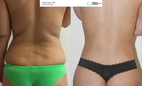 La-lipoescultura-en-Lima