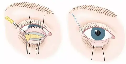 Los-tipos-de-blefaroplastia