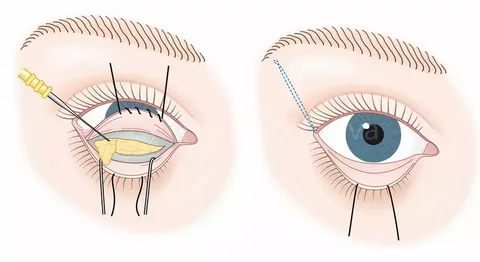 Los-tipos-de-blefaroplastia