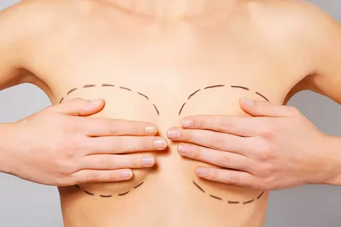 mama-o-mamoplastia