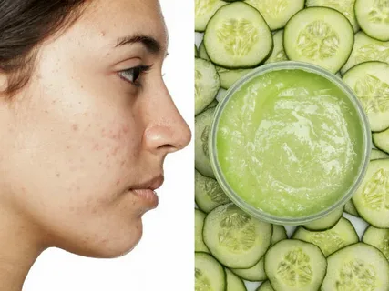 Elimina-el-acné-de-manera-natural