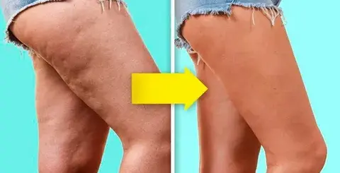 Cómo-eliminar-la-celulitis-con-la-cirugía