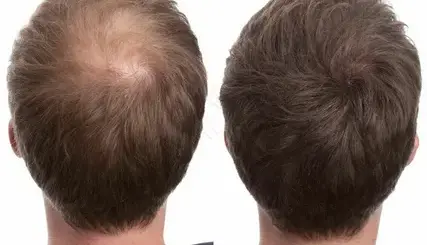 Cual-es-el-tratamiento-ideal-para-el-crecimiento-de-cabello