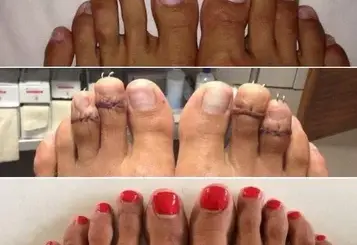 La-cirugía-estética-Pies-de-cenicienta