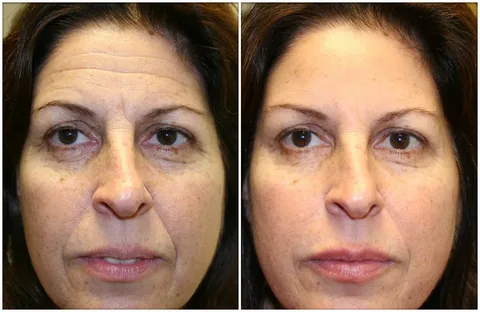 Botox-Resultados