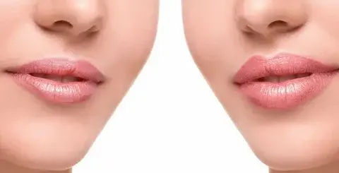 Cirugía-de-labios-en-Lima-Perú