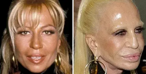 Consecuencias-del-botox