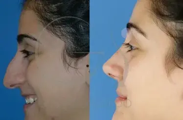 Descartando-posiblidades-negativas-después-de-una-rinoplastia