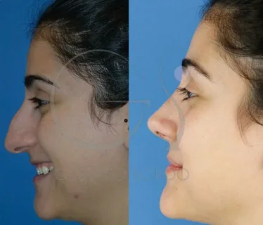 Descartando-posiblidades-negativas-después-de-una-rinoplastia