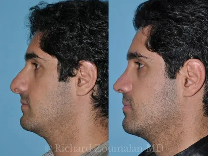 En-qué-consiste-la-rinoplastia-abierta-y-cerrada