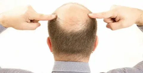 La-calvicie-en-famosos-cual-es-la-solución