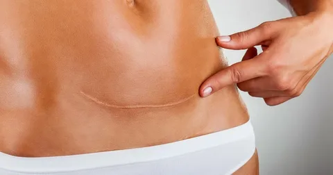 La-cirugía-estética-de-cicatrices