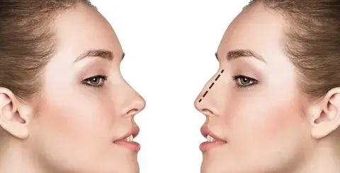 La-cirugía-estética-de-la-nariz