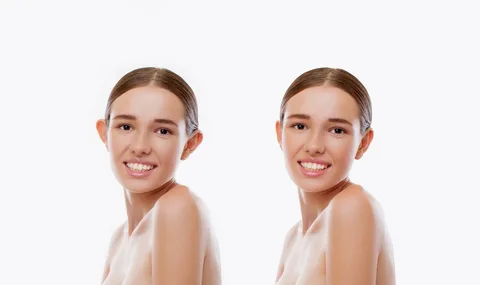 La-otoplastia-en-famosos