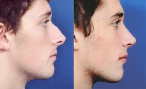 La-rinoplastia-la-solución-a-tu-problema-de-nariz
