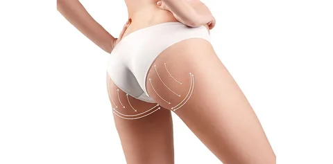 Levantamiento-de-glúteos-con-hilos-tensores