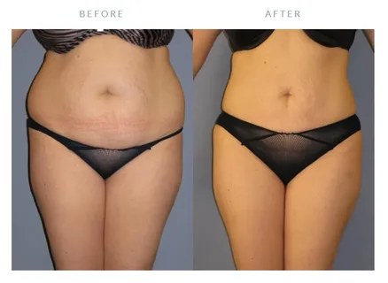 Liposucción-láser-en-Perú-Los-cuidados-luego-de-la-operación