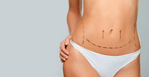 Post-operatorio-de-una-abdominoplastia