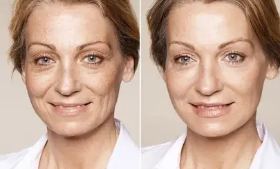 Preguntas-sobre-la-aplicación-del-botox