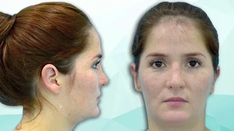 Preoperatorio-y-postoperatorio-otoplastia-Lima-Perú