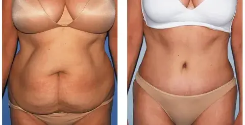 Sirve-de-relleno-a-grasa-de-la-liposucción-para-los-senos