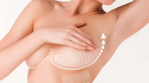 Ventajas-y-desventajas-del-aumento-de-senos