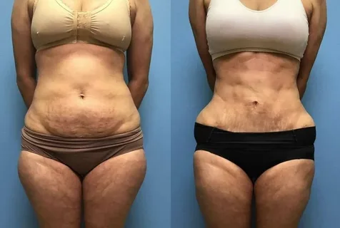 Abdominoplastia-Postoperatorio