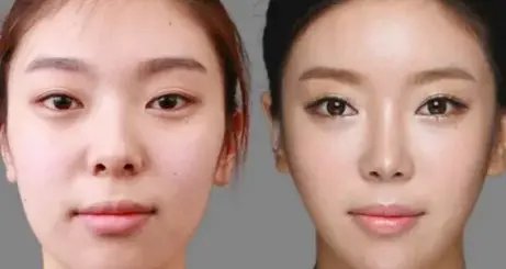 El-postoperatorio-de-mentoplastia