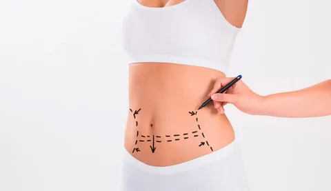 La-abdominoplastia-en-Lima-Perú