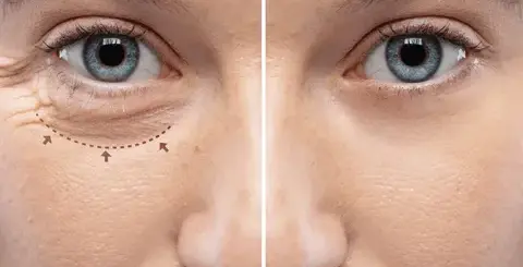 La-blefaroplastia-inferior