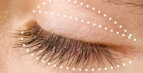 La-operación-de-parpados