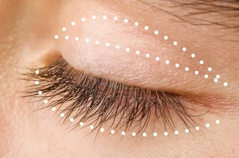 La-operación-de-parpados