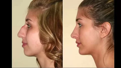 La-rinoplastia-Perú