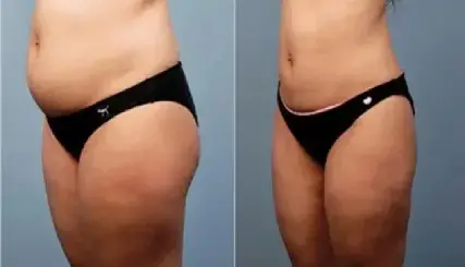 Los-diferentes-tipos-de-lipo