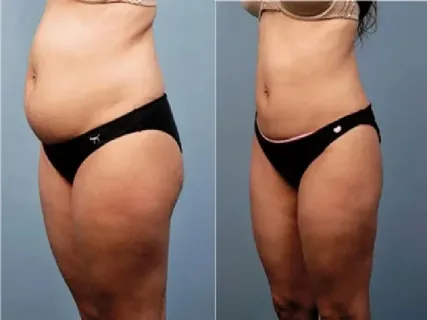 Los-diferentes-tipos-de-lipo