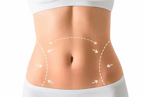 Qué-es-abdominoplastia