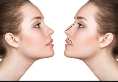 la-cirugía-plástica-nariz