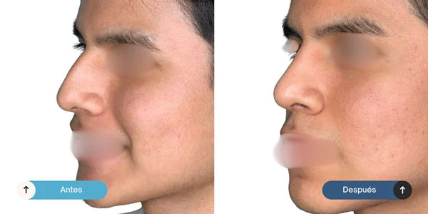 rinoplastia-antes-despues-1